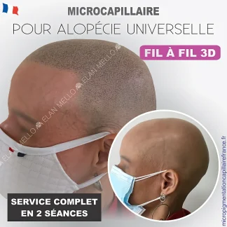 Microcapillaire Pour Allopécie Universelle –  Filà Fil 3D – Service Complet en 2 séances