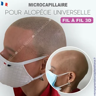 MICROCAPILLAIRE POUR L’ALOPÉCIE UNIVERSELLE - FIL À FIL 3D