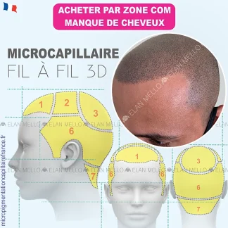 MICROCAPILLAIRE FIL À FIL 3D PAR ZONE COM MANQUE DE CHEVEUX