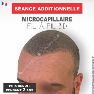 Séance Additionnelle de Microcapillaire Fil à fil 3D - Prix réduit pendant 2 ans